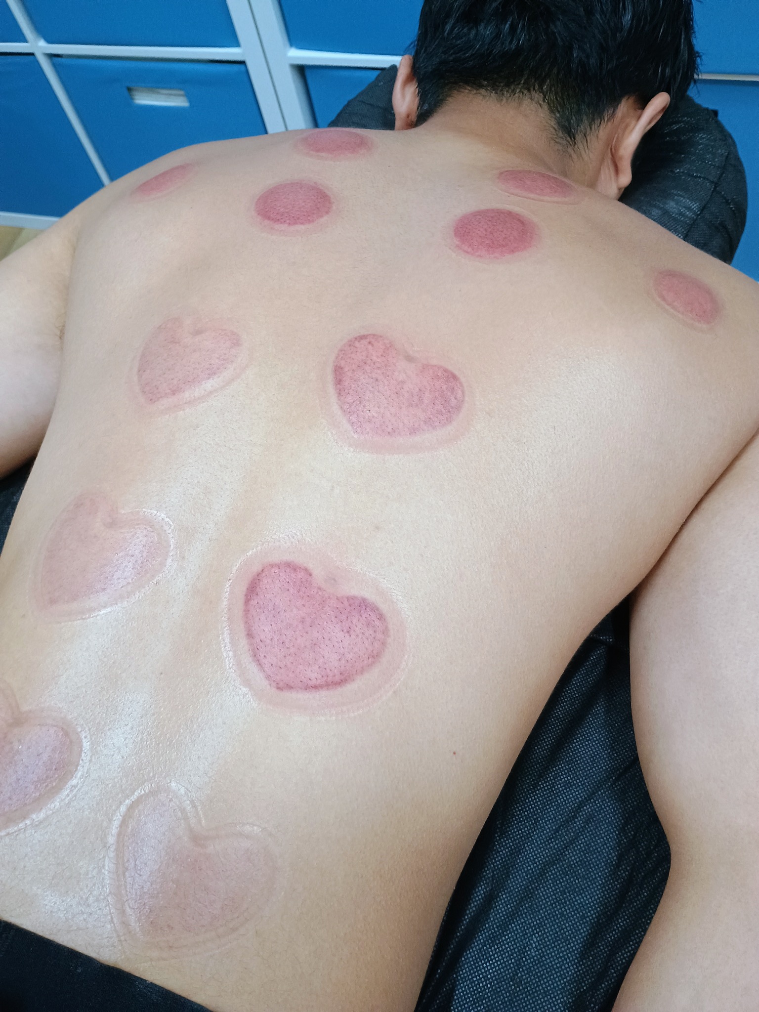 Temporary circular marks immediately after cupping therapy